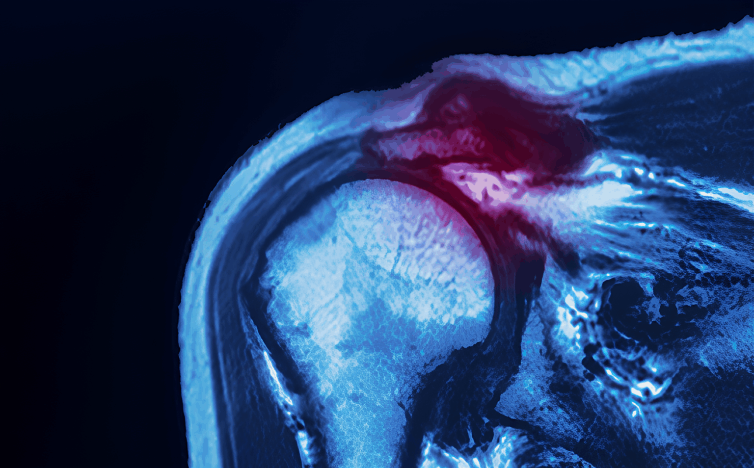 Acromioclavicular Joint Injury