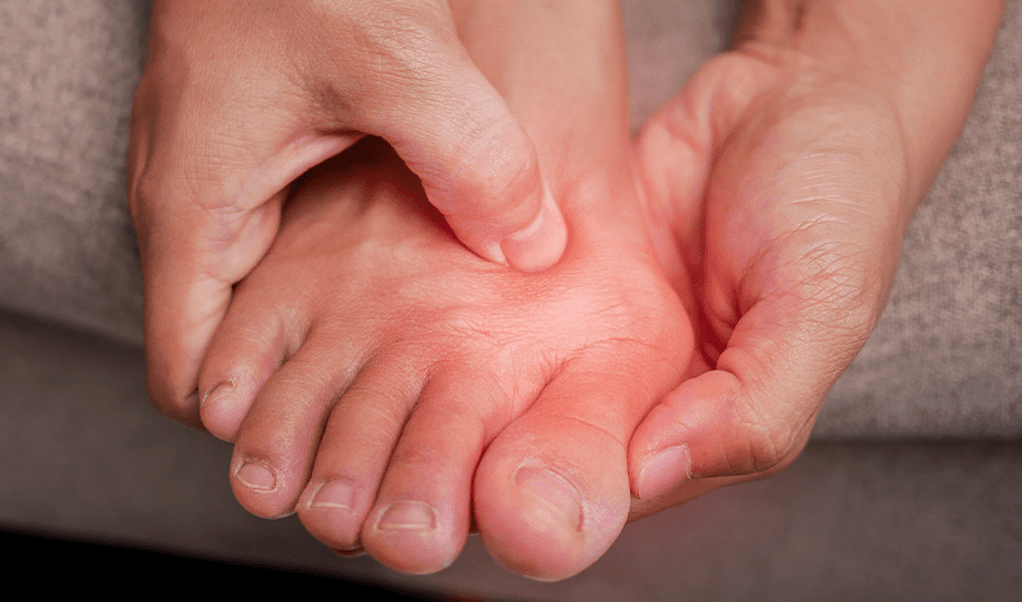 Bunions w alpha