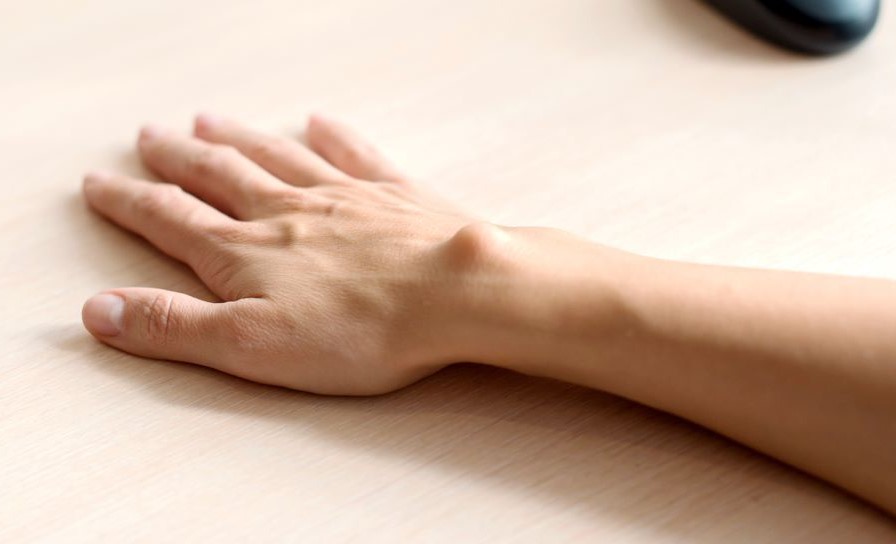 Ganglion