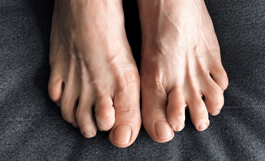 Hammer Toe w alpha