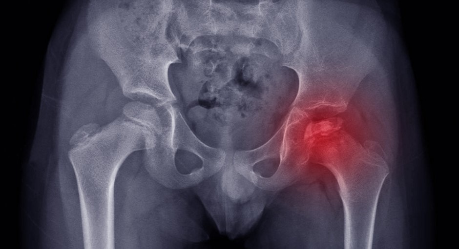 Hip Perthes Disease