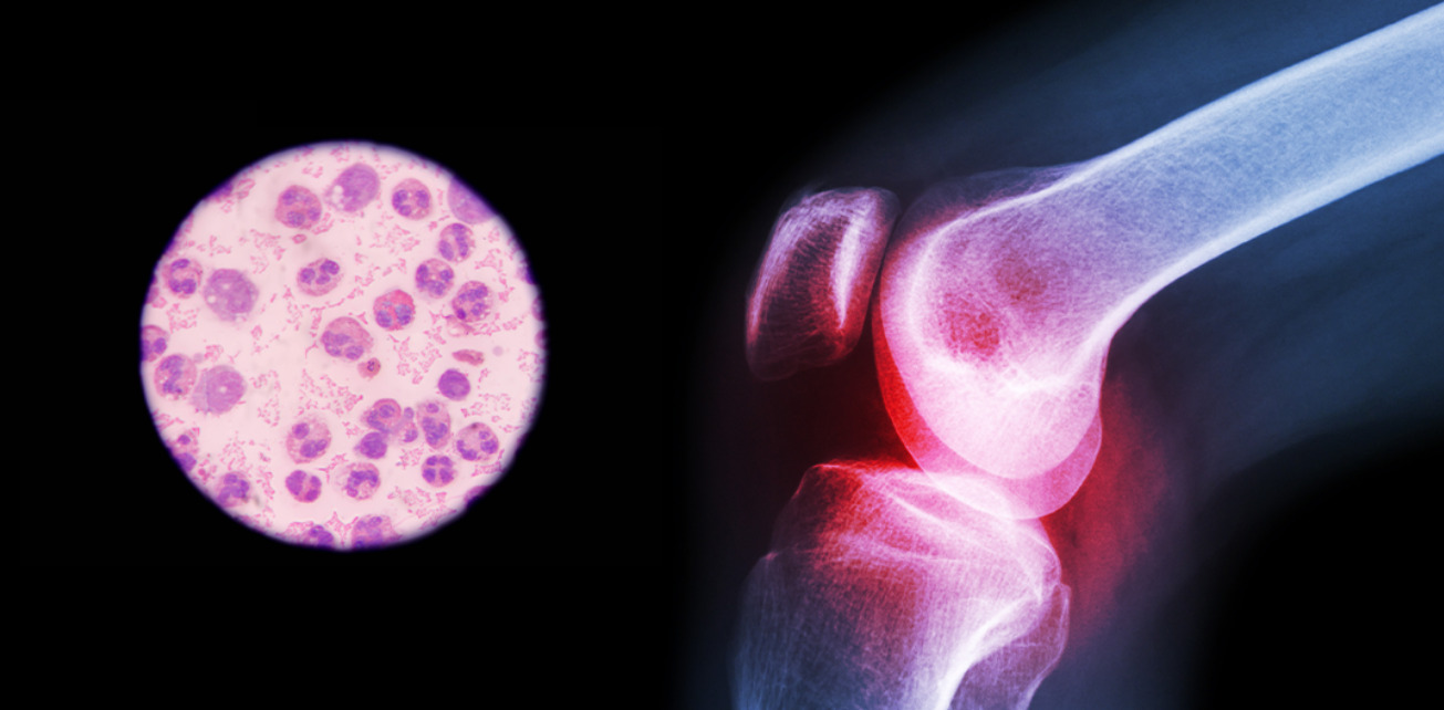 Septic Arthritis (Infectious Arthritis) in the Knee