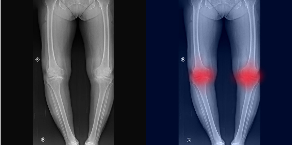 Limb Deformities Bow Legs