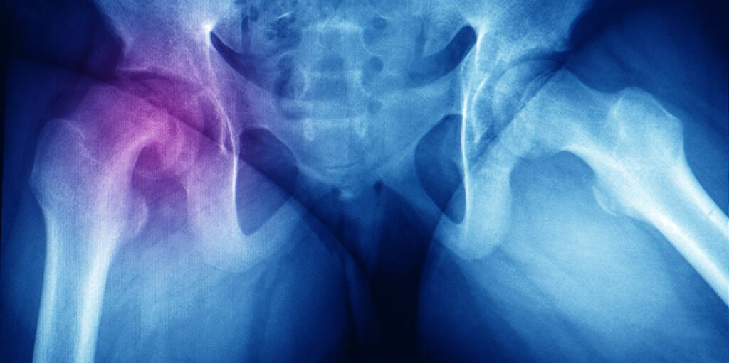 Limb Deformities Slipped Capital