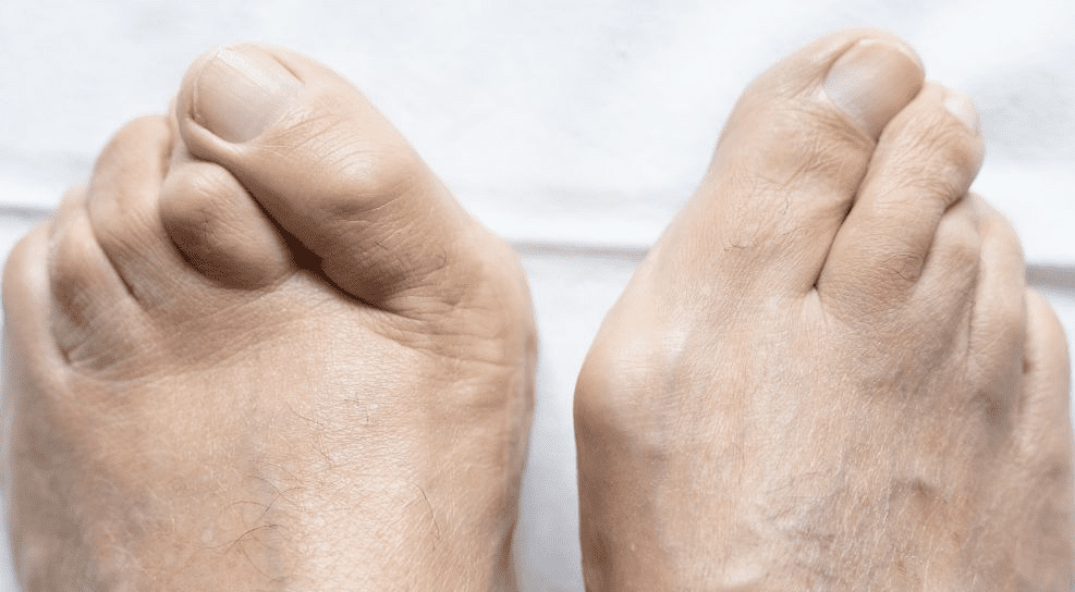 Minimally Invasive Bunion & Hammer Toe Surgery