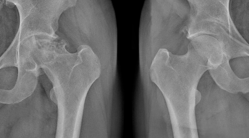 Osteonecrosis w alpha