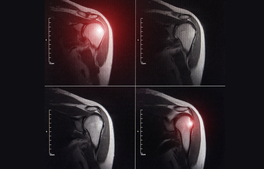 Shoulder Impingement w alpha