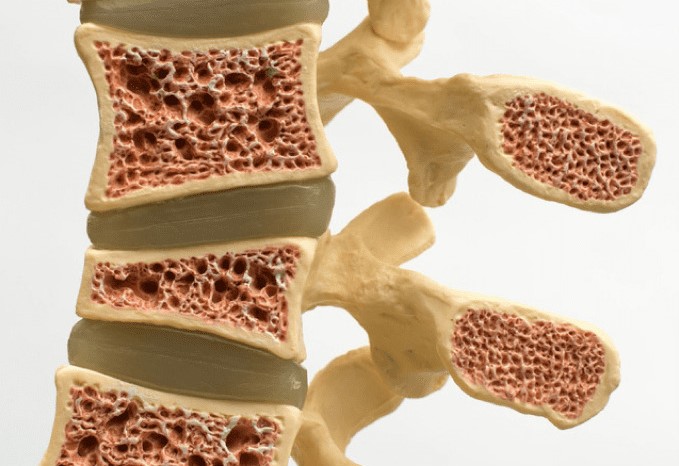 osteoporosis m