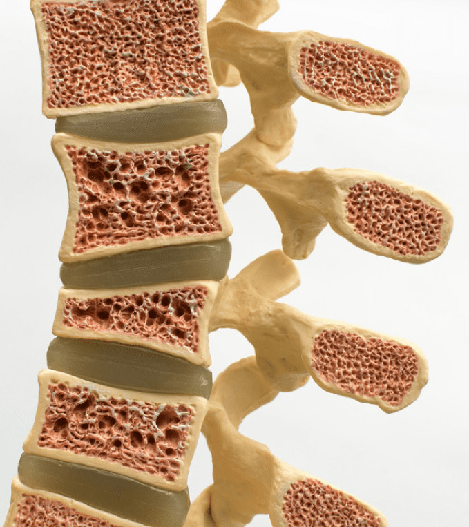 osteoporosis